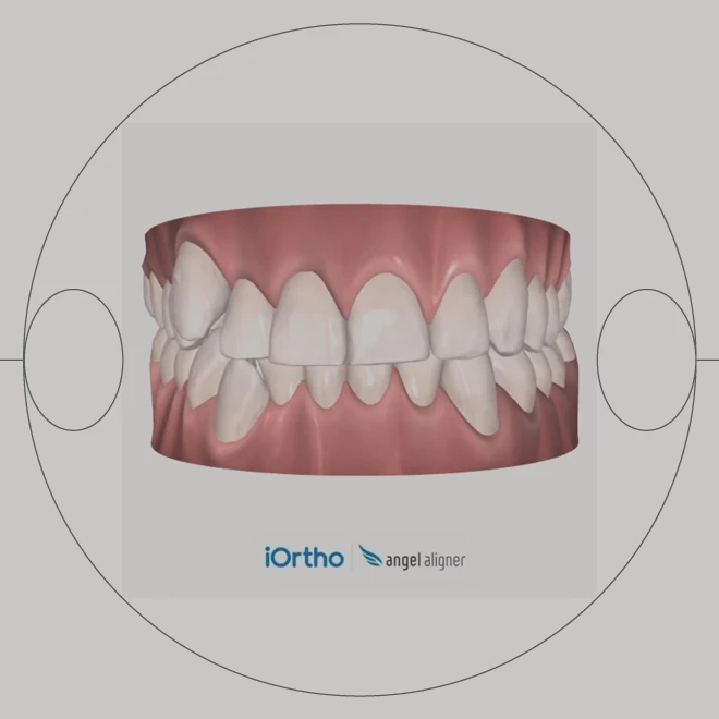 Glow Ortho digitális fogszabályzás - szemléltető ábra